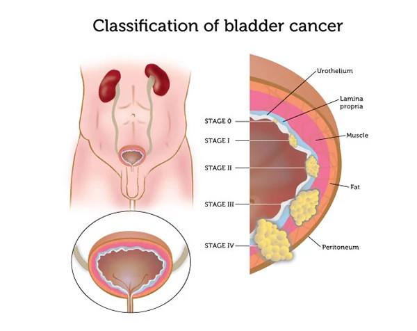 bladder-cancer-stages600x476.jpg