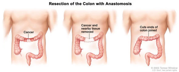 colon-resection590x240.jpg