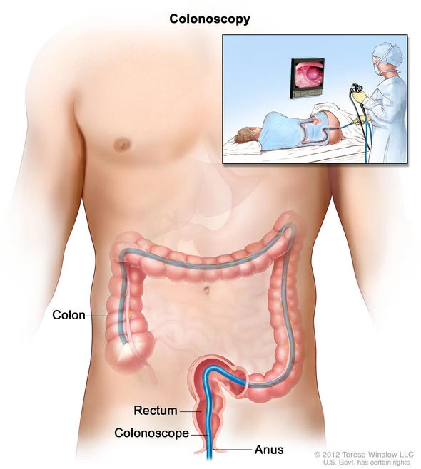 colonoscopy590x658.jpg