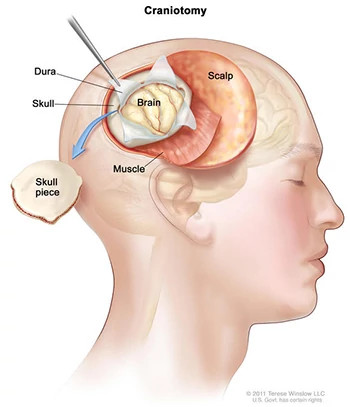 craniotomy-small350x407.jpg