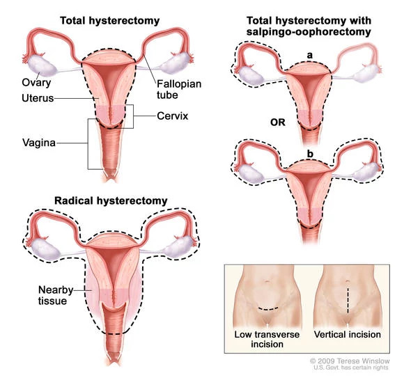 hysterectomy590x546.jpg