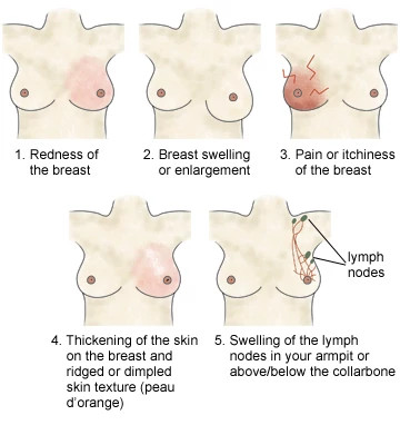 ibc-symptoms360x382.jpg