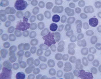 leukemia-cells-large350x272.jpg