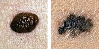 moles-border200x100.jpg