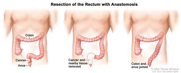 rectum-resection590x240.jpg