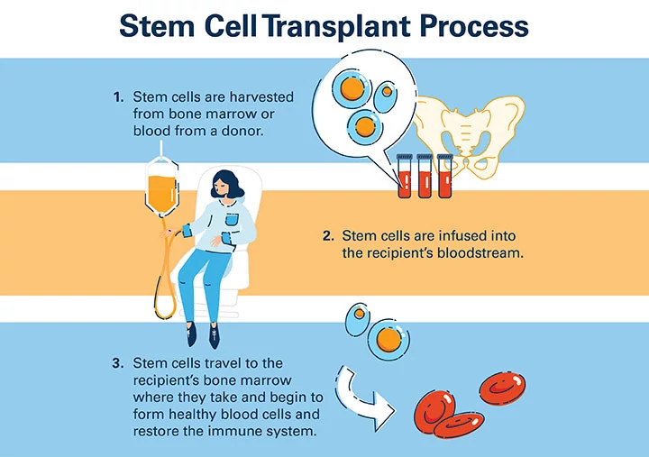 stem-cell-transplant-process720x507.jpg