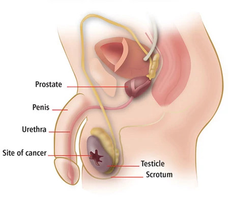 testicular-cancer-illustration450x402.jpg